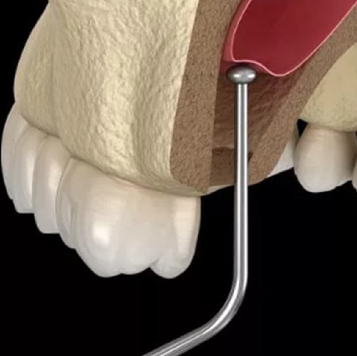 پیوند استخوان فک - مرکز دندانپزشکی گیشا آرام