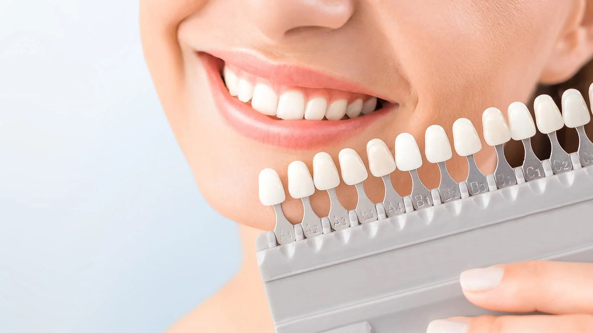 آفیس بلیچینگ- مرکز دندانپزشکی گیشا آرام