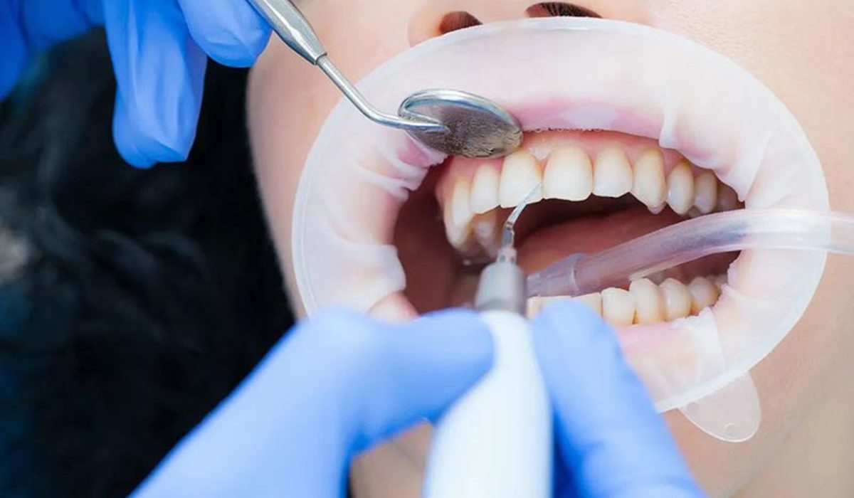 مدت زمان جرم گیری دندان- مرکز دندانپزشکی گیشا آرام