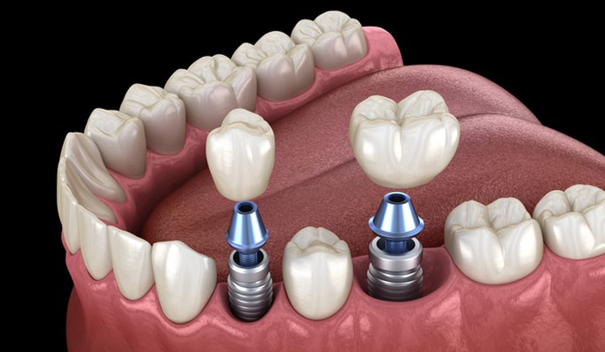 مینی ایمپلنت دندان-مرکز دندانپزشکی گیشا آرام