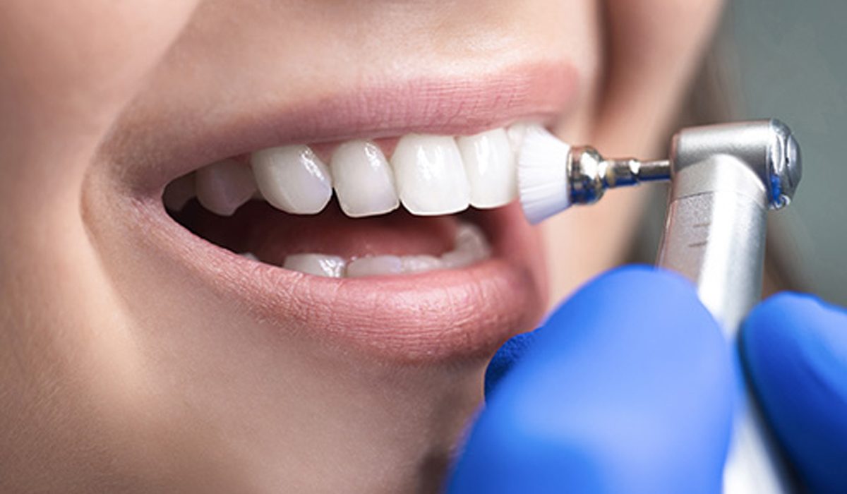 نحوه جرم گیری دندان- مرکز دندانپزشکی گیشا آرام