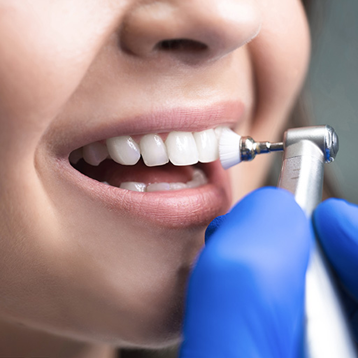 نحوه جرم گیری دندان- مرکز دندانپزشکی گیشا آرام