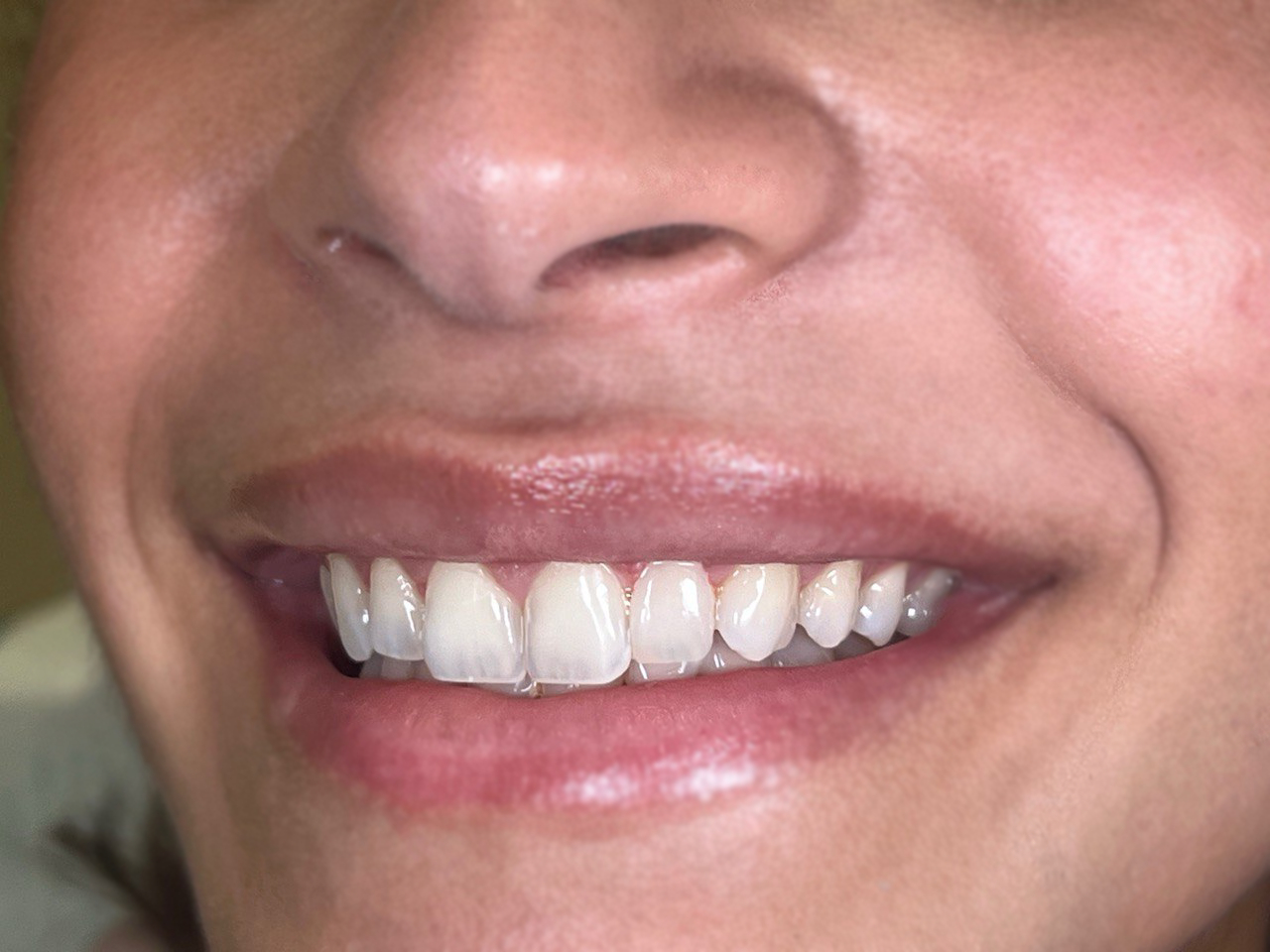 کامپوزیت ونیر دندانپزشکی گیشا آرام