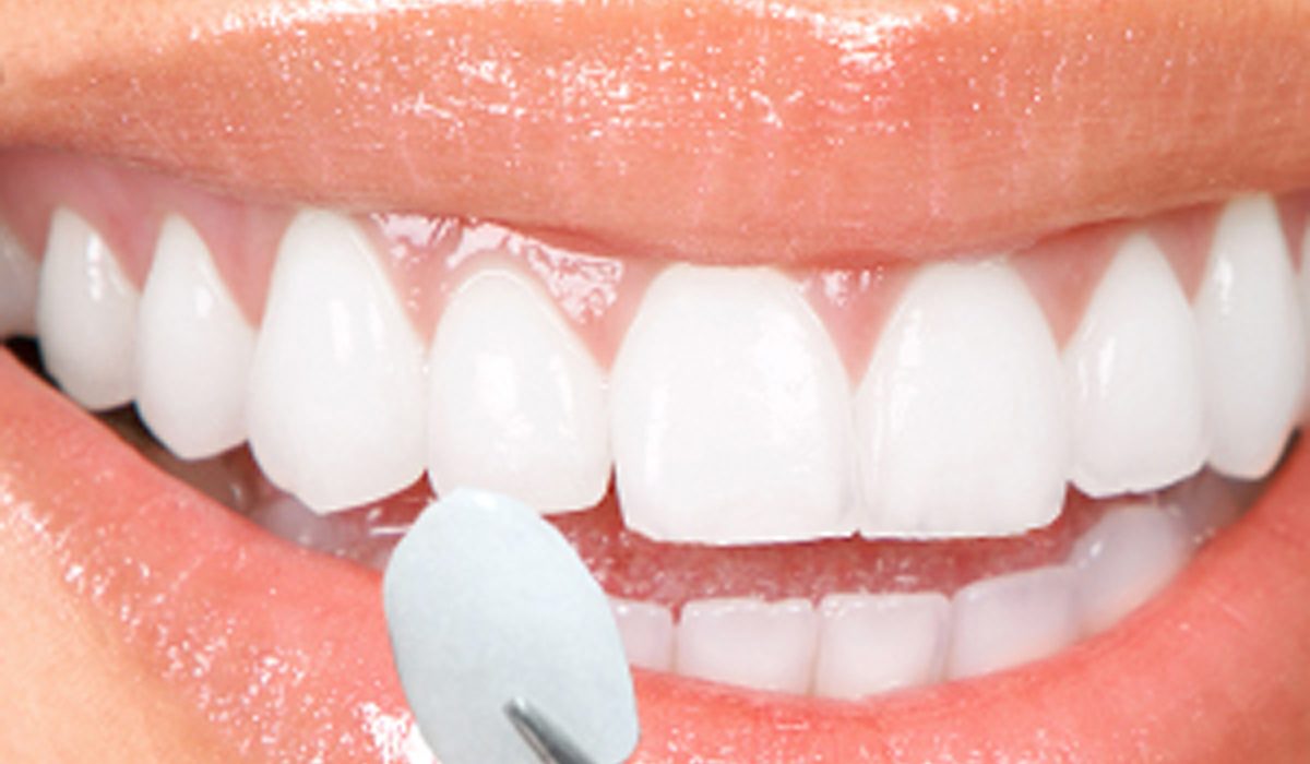 کامپوزیت ونیر غیر مستقیم -مرکز دندانپزشکی گیشا آرام