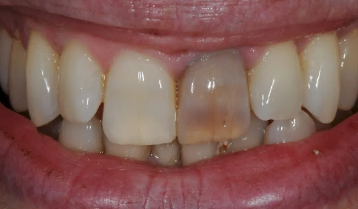 سیاه شدن دندان- دندانپزشکی گیشا آرام