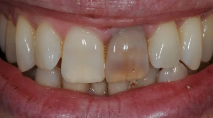 سیاه شدن دندان- دندانپزشکی گیشا آرام