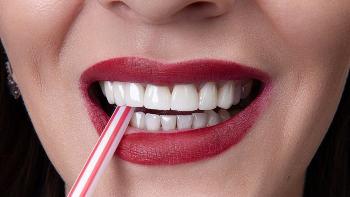 هزینه کامپوزیت دندان- دندانپزشکی گیشا آرام