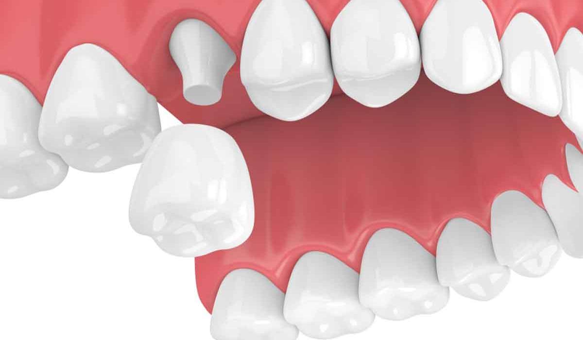 هزینه روکش دندان- دنانپزشکی گیشا آرام دنتال