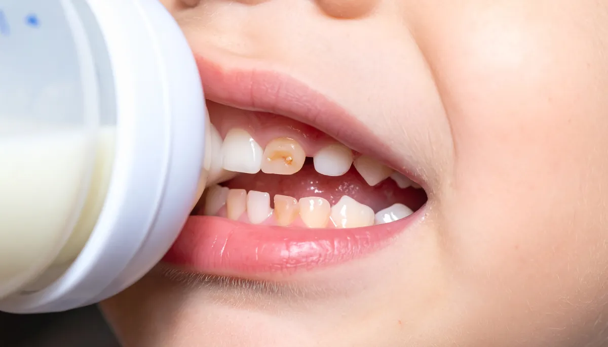 دندان شیری کودک- دندانپزشکی گیشا آرام دنتال