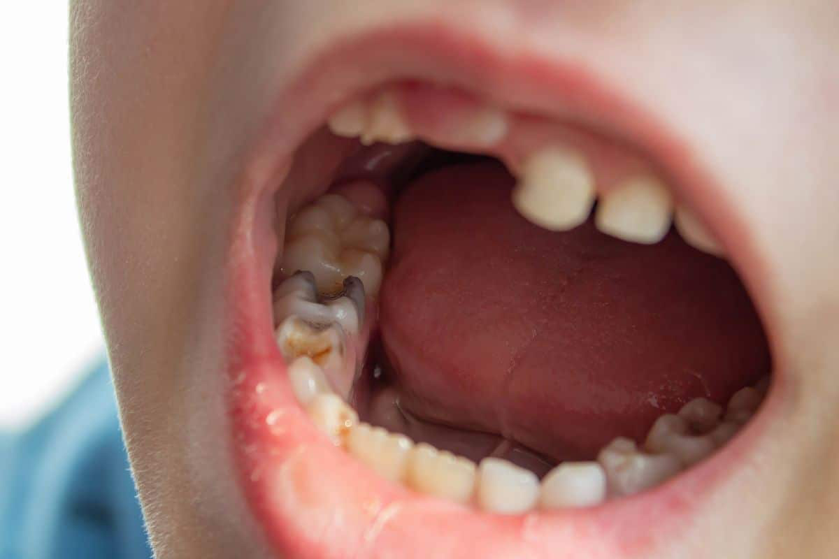 عفونت دندان کودک- دندانپزشکی گیشا آرام دنتال