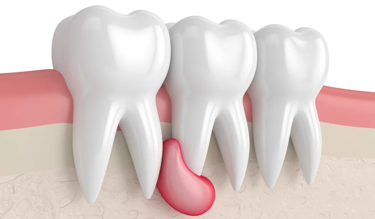 کیست دندان کودکان- دندانپزشکی گیشا آرام دنتال