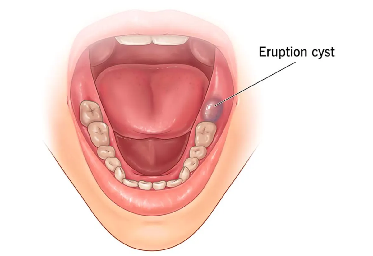 کیست دندان کودکان- دندانپزشکی گیشا آرام دنتال