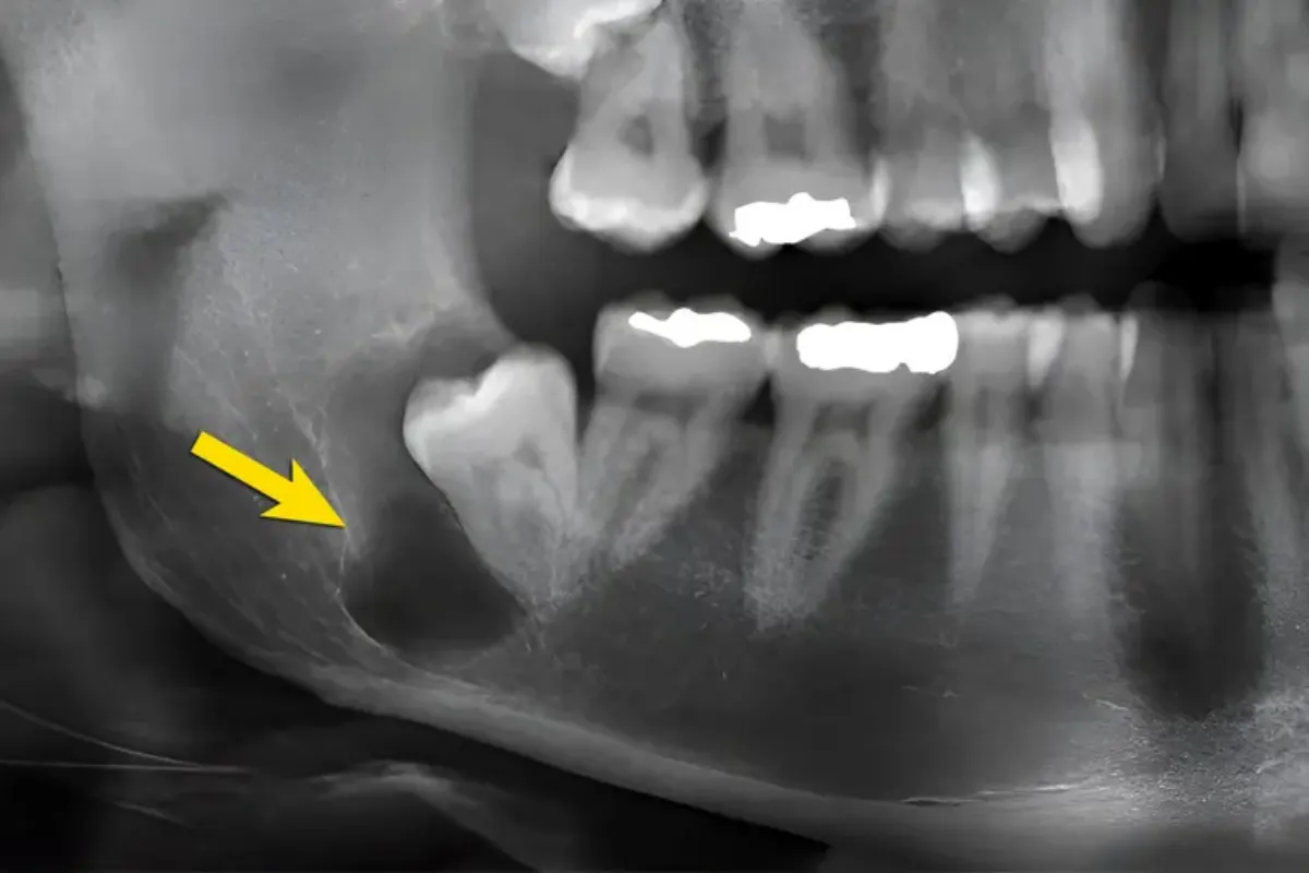 کیست دندان کودکان- دندانپزشکی گیشا آرام دنتال