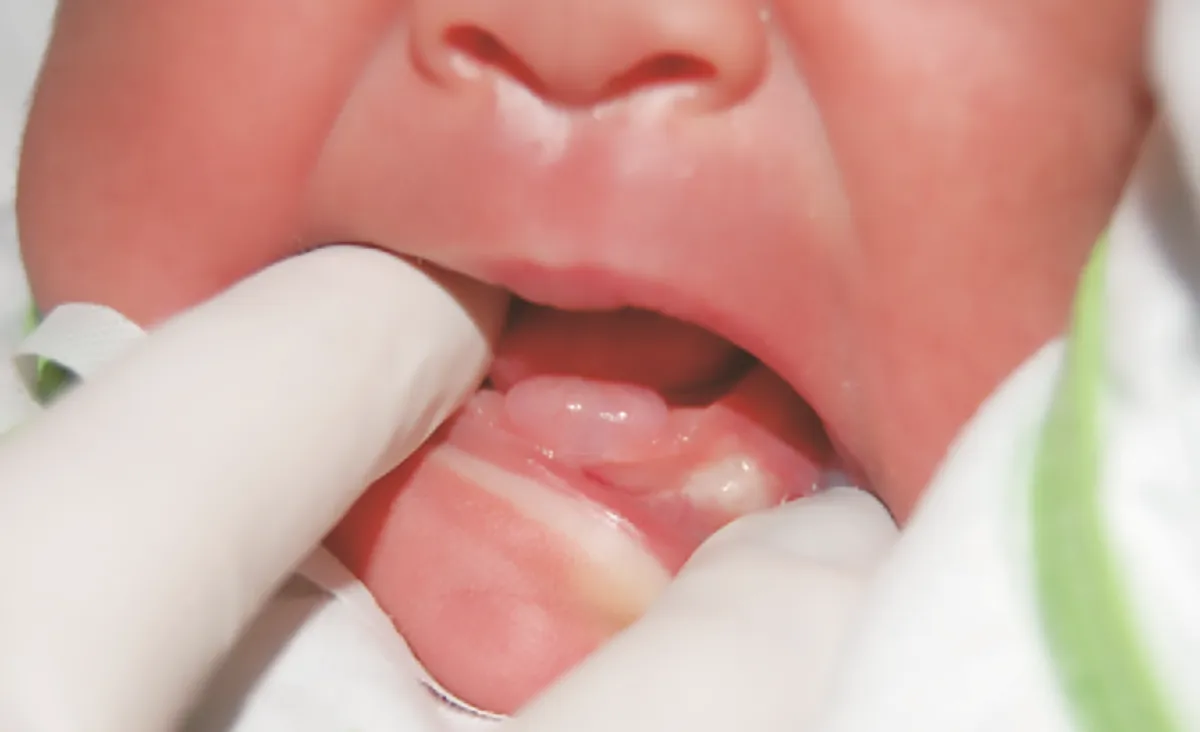 کیست دندان نوزاد- دندانپزشکی گیشا آرام دنتال